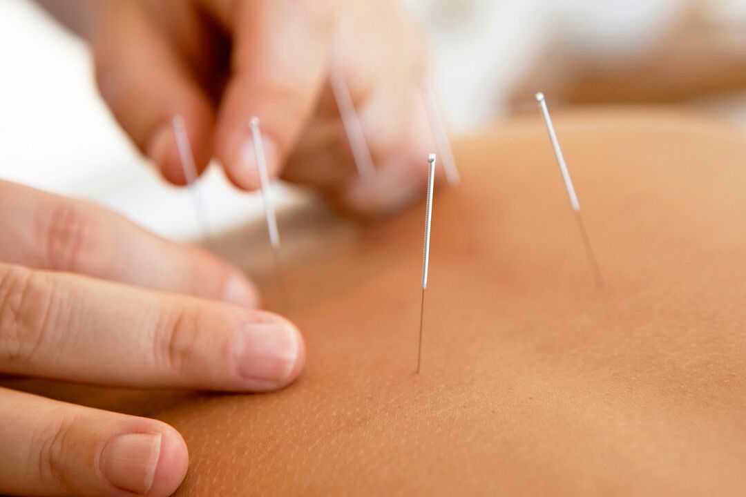 akupunktura na zwiększenie potencji