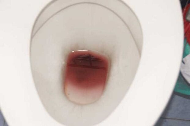 plamienie u mężczyzn podekscytowanych